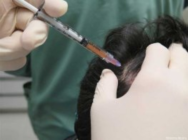 Prp Hair Treatment