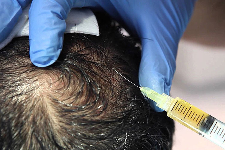 Prp Hair Treatment